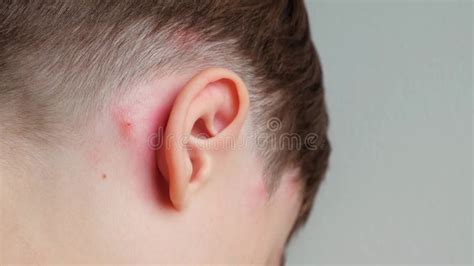 Concept Of Allergic Reaction By Mosquito Bites Ear Close Up Stock