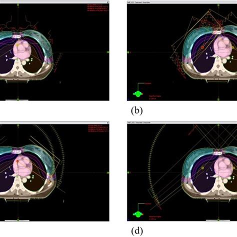 Dose Distributions On An Axial View Of A Imrt Iso1 B Imrt Iso2