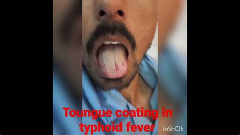 Tongue Coating In Typhoid Fever Youtube