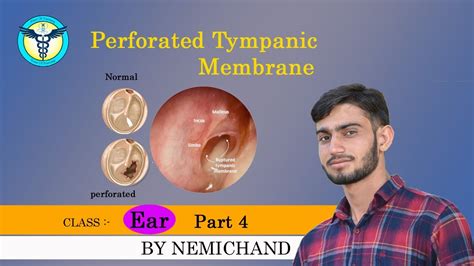 Tympanic Membrane Perforation