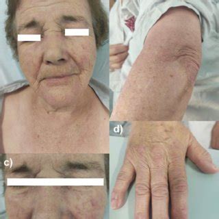 Dermatomyositis Skin Rash A V Sign And Heliotrope Facial Erythema