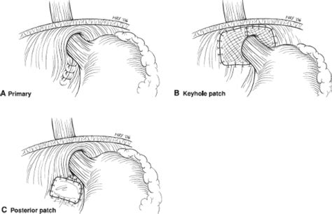 Open Paraesophageal Hernia Repair Basicmedical Key