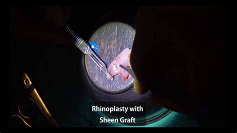 Rhinoplasty With Sheen Graft Procedure Ozge Ergun MD Plastic