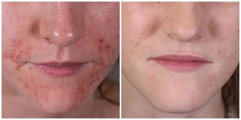 Perioral Dermatitis Before And After Yin Yang Dermatology Holistic