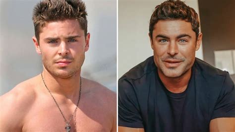 ¿fue Cirugía Zac Efron Rompe El Silencio Sobre La Transformación De Su