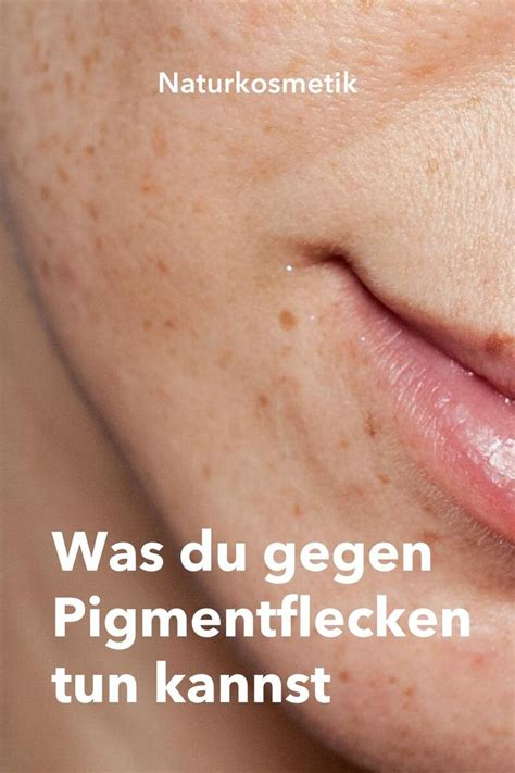 Auf natürliche Weise im Gesicht Pigmentflecken entfernen 5 effektive