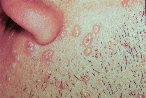 Can You Get Chickenpox Twice? Chances, Causes, and More