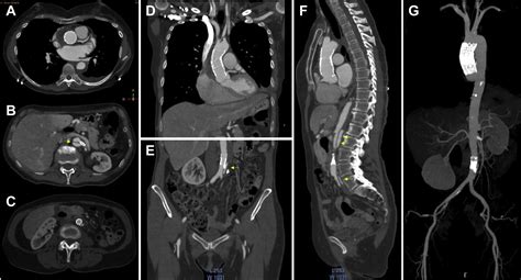 Transapical Endovascular Repair Of Iatrogenic Type A Aortic Dissection