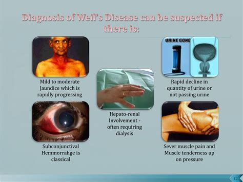 Ppt Description Of Acute Febrile Illness Powerpoint Presentation