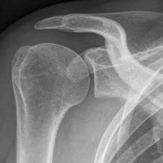 Consort Flowchart Group Sad Arthroscopic Subacromial Decompression