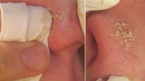 Pimple-popping videos are gross - so what it is that makes us watch ...