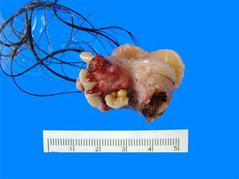 Top 48 Image Teeth And Hair Cyst Vn