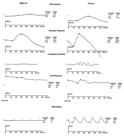 Full Field Electroretinographic Recordings Of Both The Eyes Showing