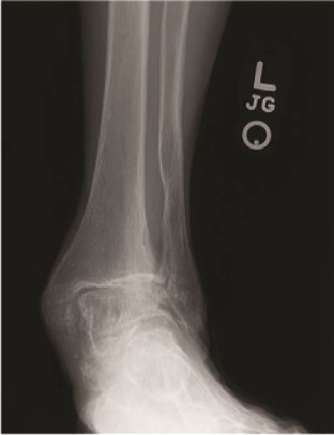 Deltoid Ligament Of Ankle