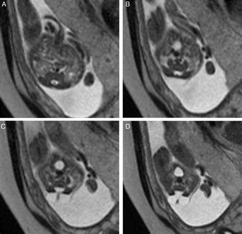 Imágenes T2w Haste En Plano Axial Desde Cefálico A Hacia Caudal D