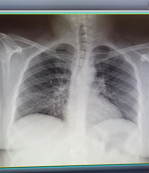 Anything interesting about these lungs? (Other than the weight of the