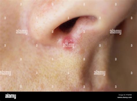 Pimple on the face of the girl near the nose, acne, macro Stock Photo ...