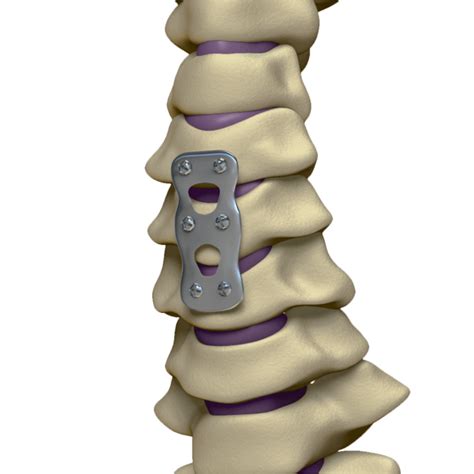 Artrodese De Lombar Especialista Em Coluna Em S O Paulo