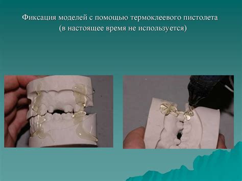 Фиксация моделей в окклюдатор - online presentation