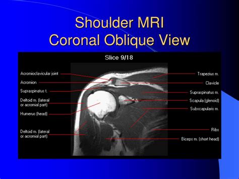 Shoulder Bursa Mri