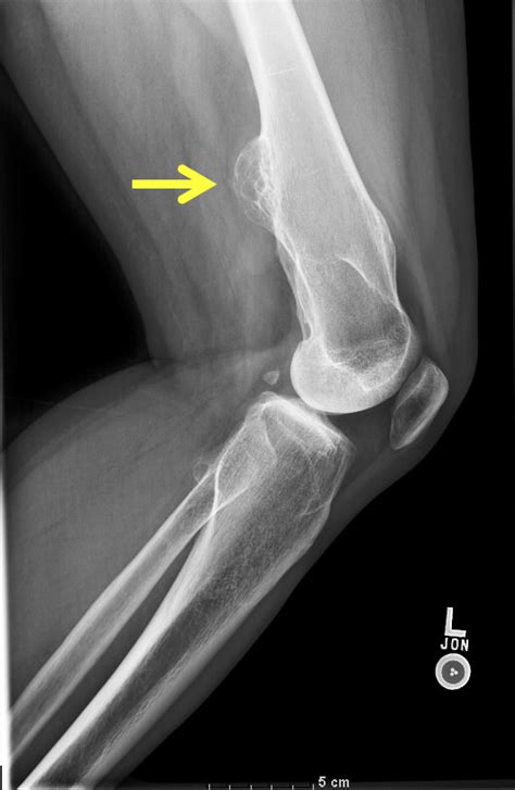 Pathology Outlines Osteochondroma