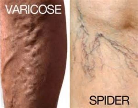 Spider Veins Causes Prevention And Treatment