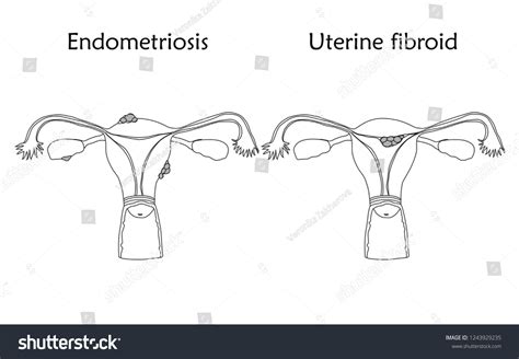 Endometriosis Uterine Fibroid Human Realistic Uterus Stock Vector