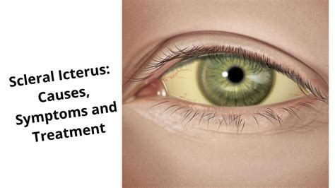 Scleral Icterus: List of Causes, Symptoms and Treatment