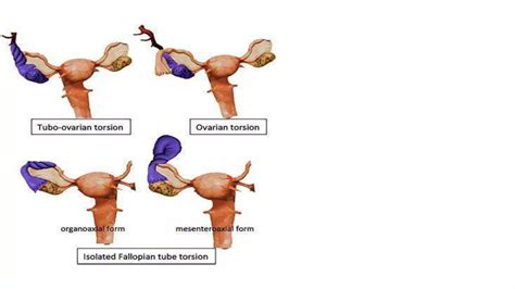 Ovarian Torsionpptx