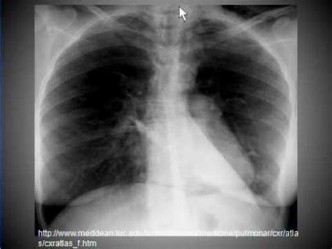 Chest x-ray --Pneumomediastinum - YouTube