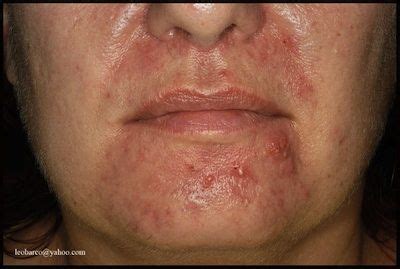 Perioral Dermatitis Causes Symptoms And Treatment Artofit