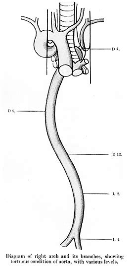 Tortuous aorta - meddic