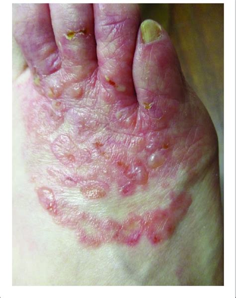 Vesiculobullous Inflammatory Tinea Pedis Presenting With Pruritic