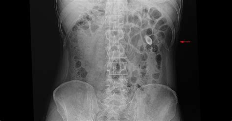 Symptoms of Kidney Stones - Beaumont Emergency Hospital