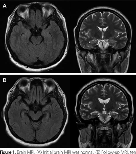 Figure 1 From Anti Nmda Receptor Encephalitis In A Pregnant Woman Semantic Scholar