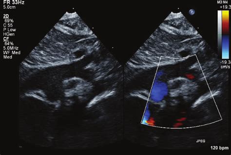 Suprasternal Notch Echo