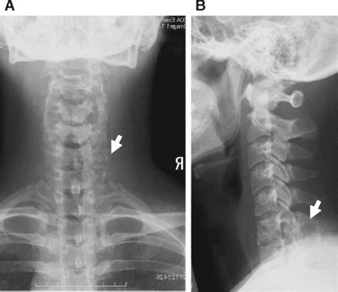 Aggressive osteoblastoma of the cervical spine involving the canal and vertebral artery: a case ...