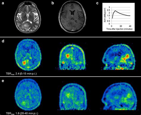 visual    anaplastic astrocytoma  grade iii