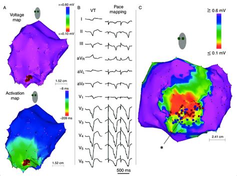 A Voltage Map Upper Panel And Activation Map Lower Panel Of The