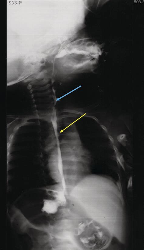 Barium Esophagram Demonstrating An Upper Blue Arrow And Middle