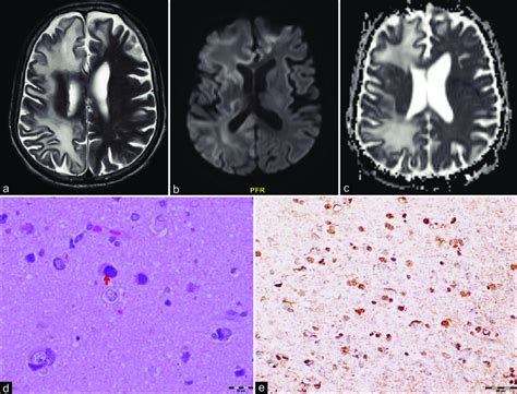 Brain MRI showing a) T2 axial showing asymmetric white matter tract ...