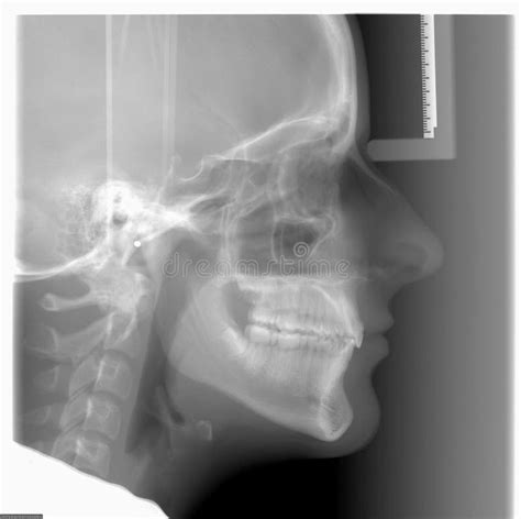 Cephalometric X-ray stock photo. Image of xray, black - 6812250