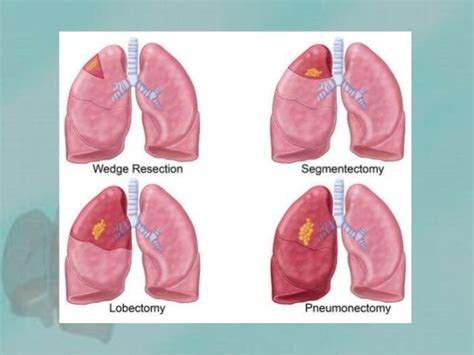 Lung cancer surgery