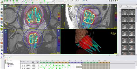 Brachytherapy (HDR & LDR) - UCSF Department of Radiation Oncology