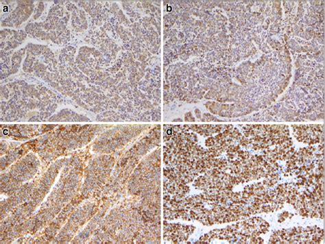 Immunopathological Examination Synaptophysin A Chromogranin A B