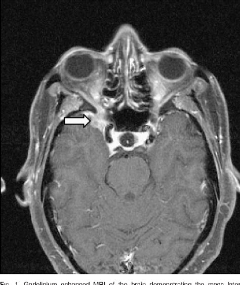 Figure 1 From Rituximab In Rheumatoid Arthritis Following Anti Tnf Associated Tuberculosis