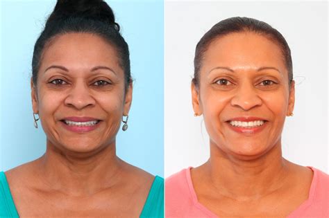 Botox Cosmetic Photos Houston Tx Patient