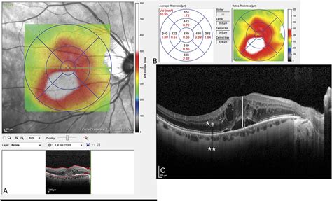 Integrity Of Outer Retinal Layers After Resolution Of Centra Retina