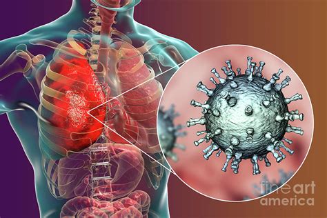 Pneumonia Caused By Varicella Zoster Virus Photograph By Kateryna Kon