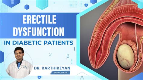 Erectile Dysfunction In Diabetic Patients Dr Karthikeyan Youtube